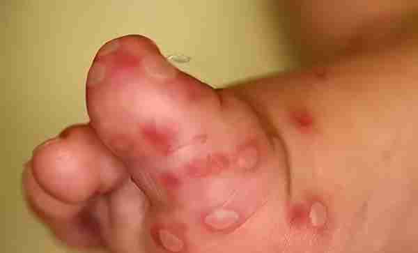 孩子得了手足口病，为啥指甲还脱落了？