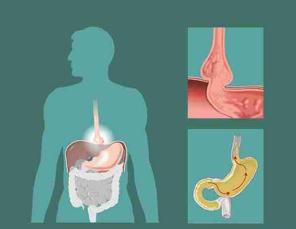 慢性肠胃炎怎么治？医生：5种方法可缓解，保持好的心态很重要